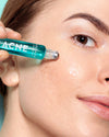 Madara ACNE Acute Spot Täsmähoito Roll-on; malli levittää roll-onia poskelleen